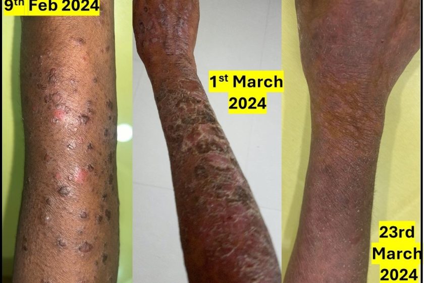 Autoimmune Disease